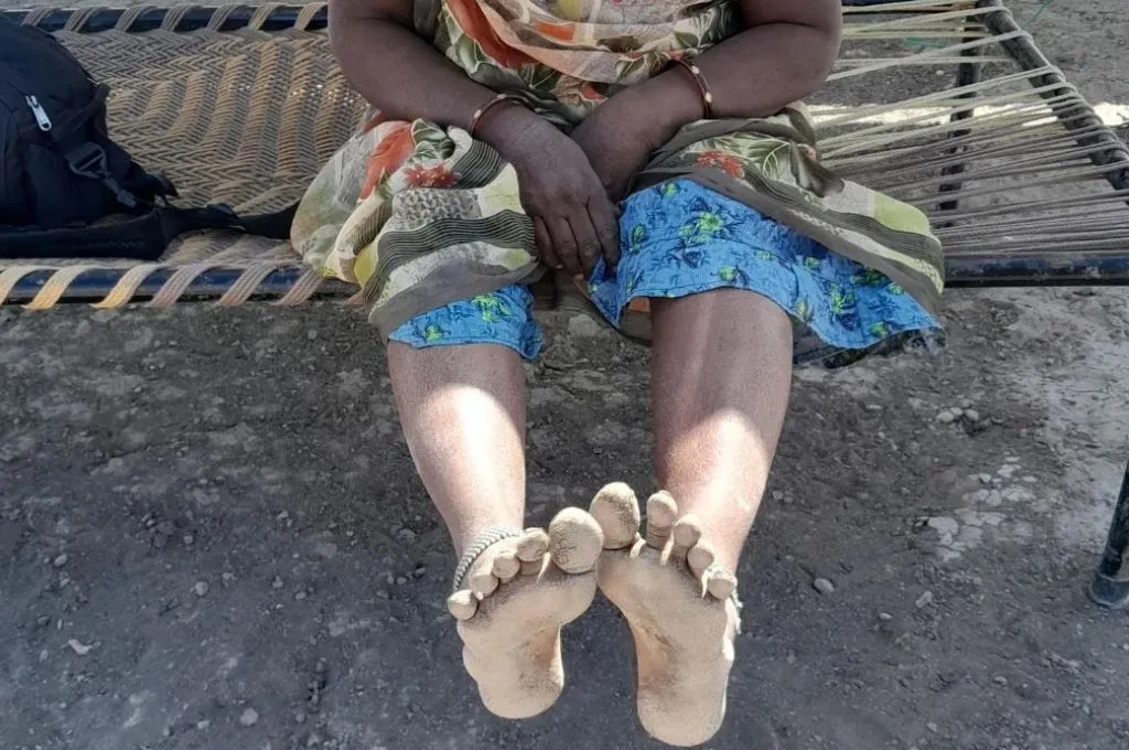 एक महिला किसान अपने पैर दिखा रही है, जिनमें छाले और सूजन है_सॉल्ट पैन 
